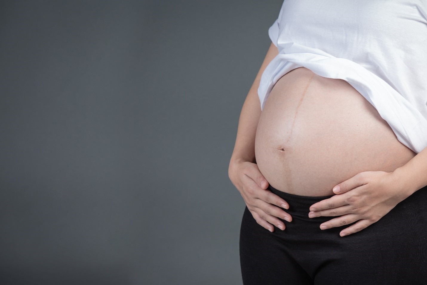 סימני מתיחה בהיריון – כל מה שצריך לדעת
